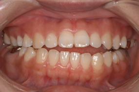 図２：顎偏位を伴った中程度の開咬